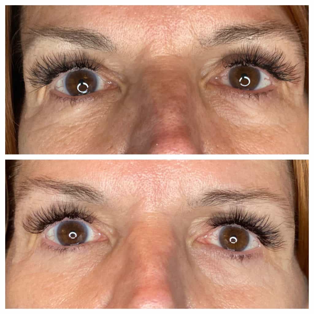 Opus Plasma Treatment on Eyes - Before and After