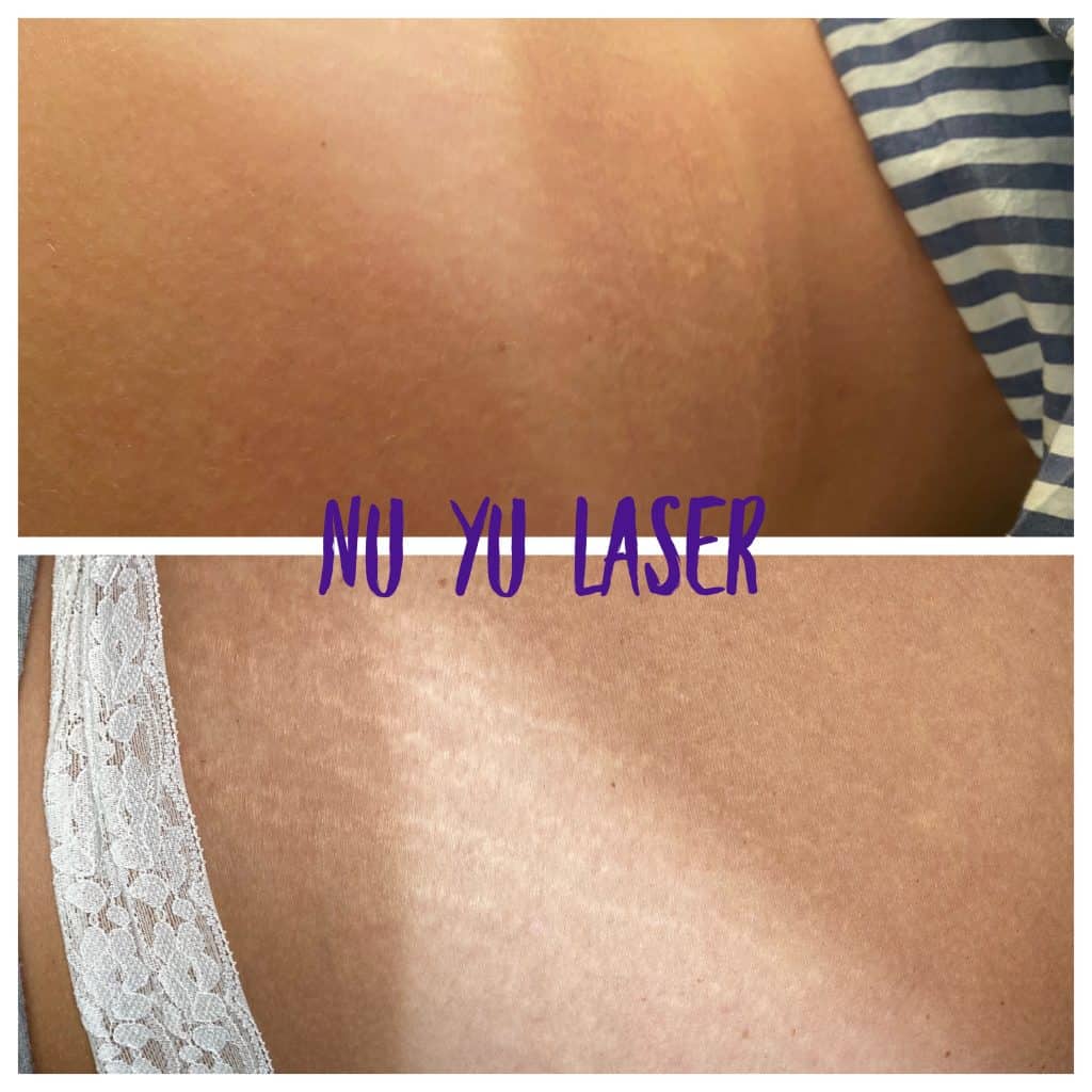Opus Laser Treatment Before and After