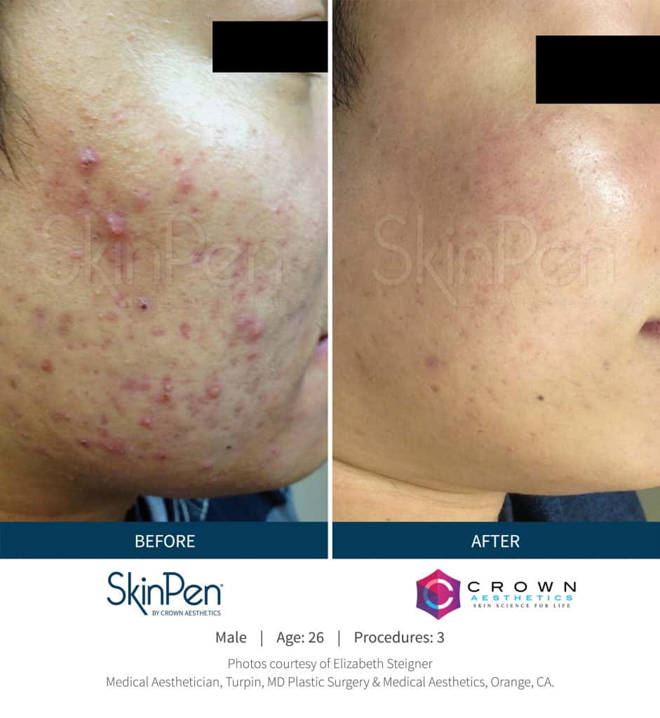 Skin Pen Acne Treatment Before and After