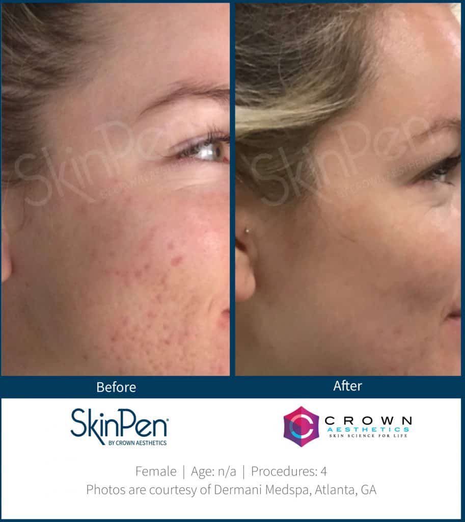 Skin Pen Treatment on Face - Before and After
