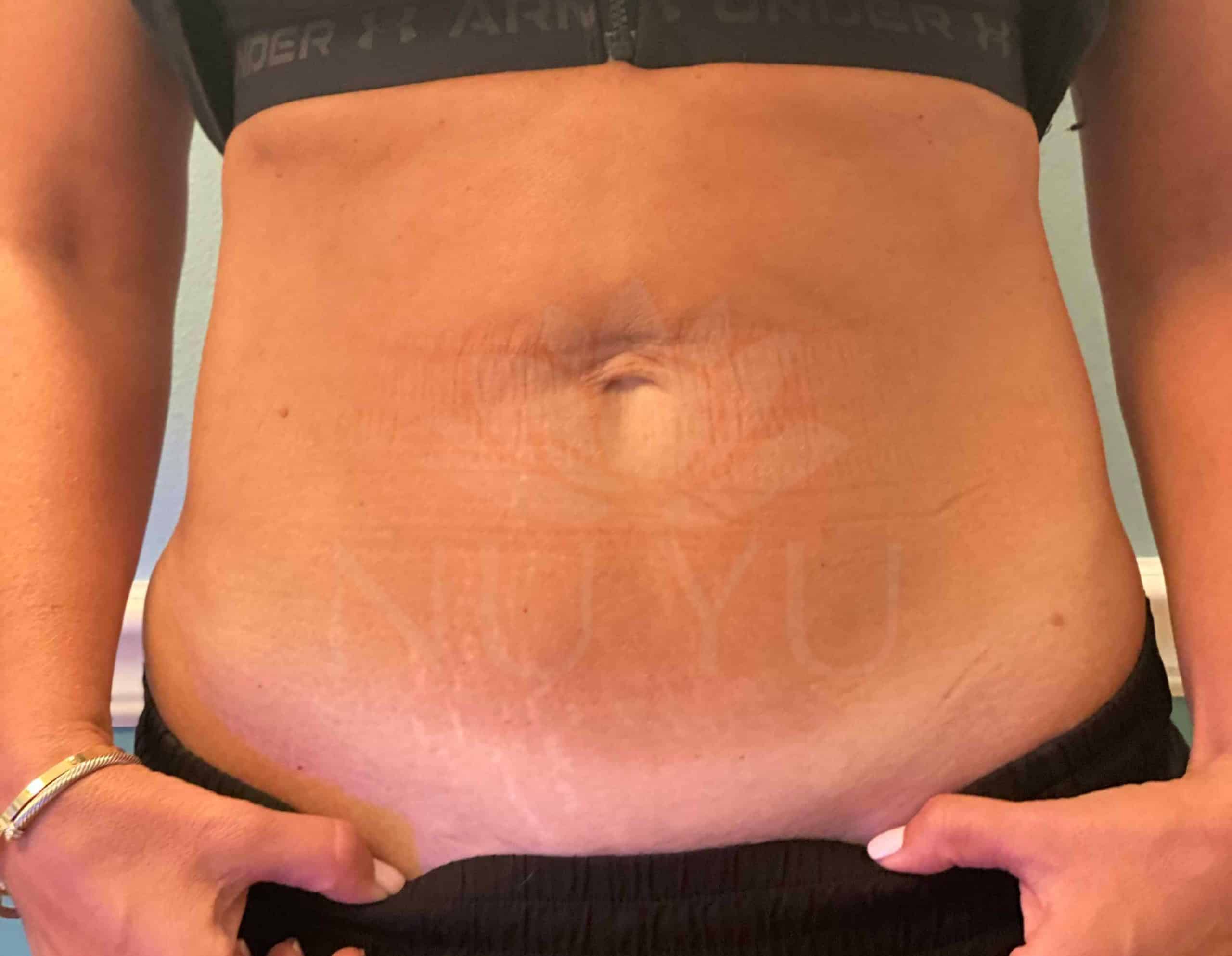 Opus Plasma Stomach Skin Treatment After