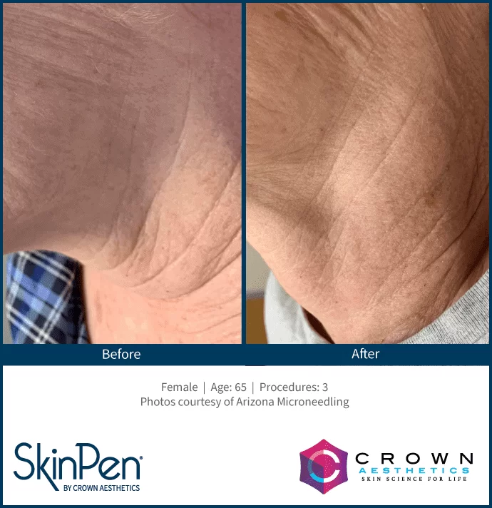 Skin Pen Before and After